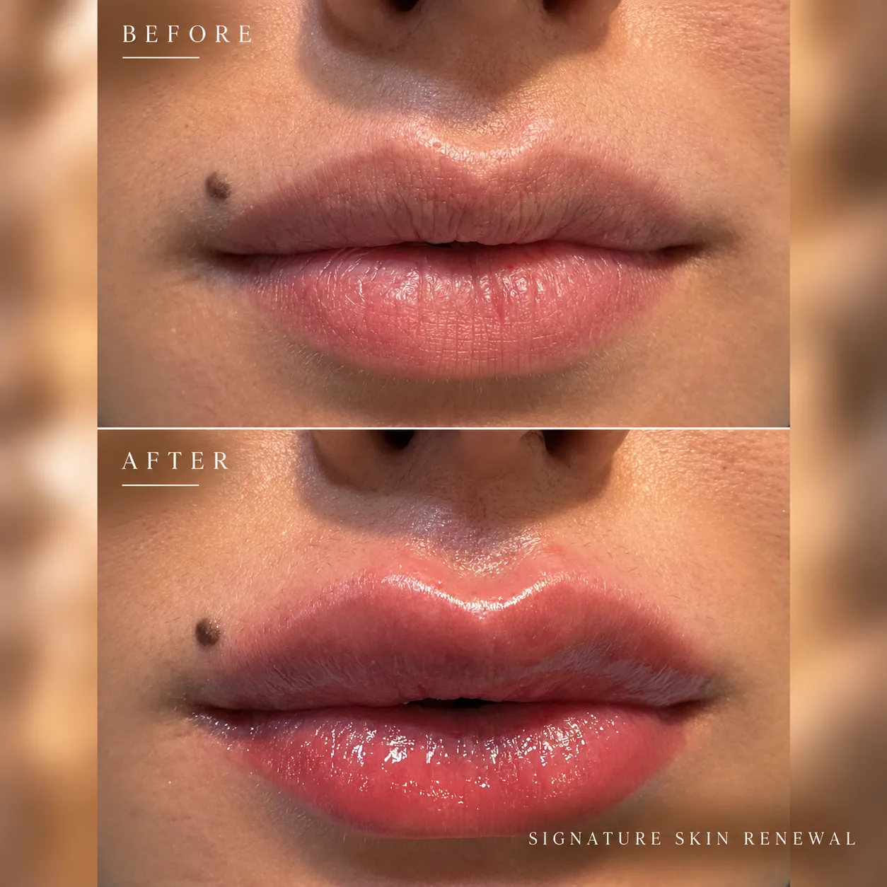 Before & After Lip Enhancement_11zon