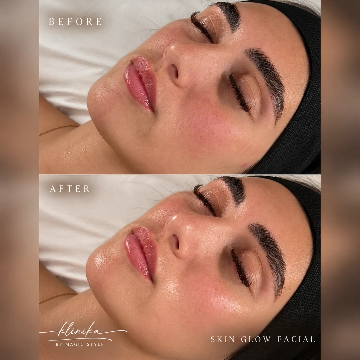 Before & After Skin Glow Facial_11zon