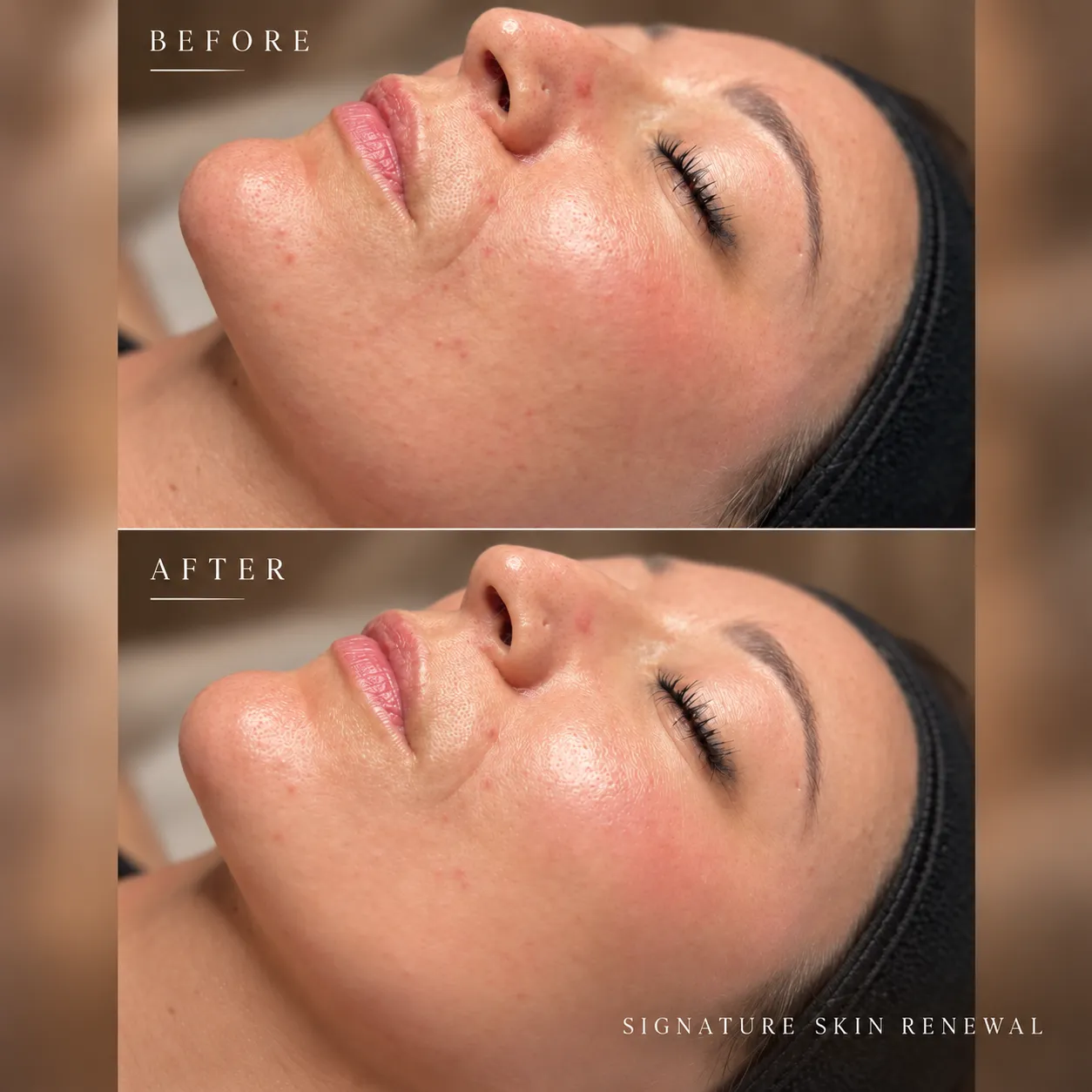 Before and After Skin Renewal_11zon