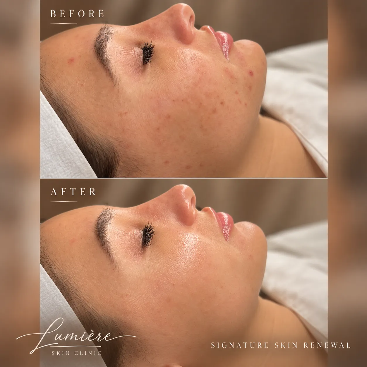 Lumière Skin Renewal Before and After