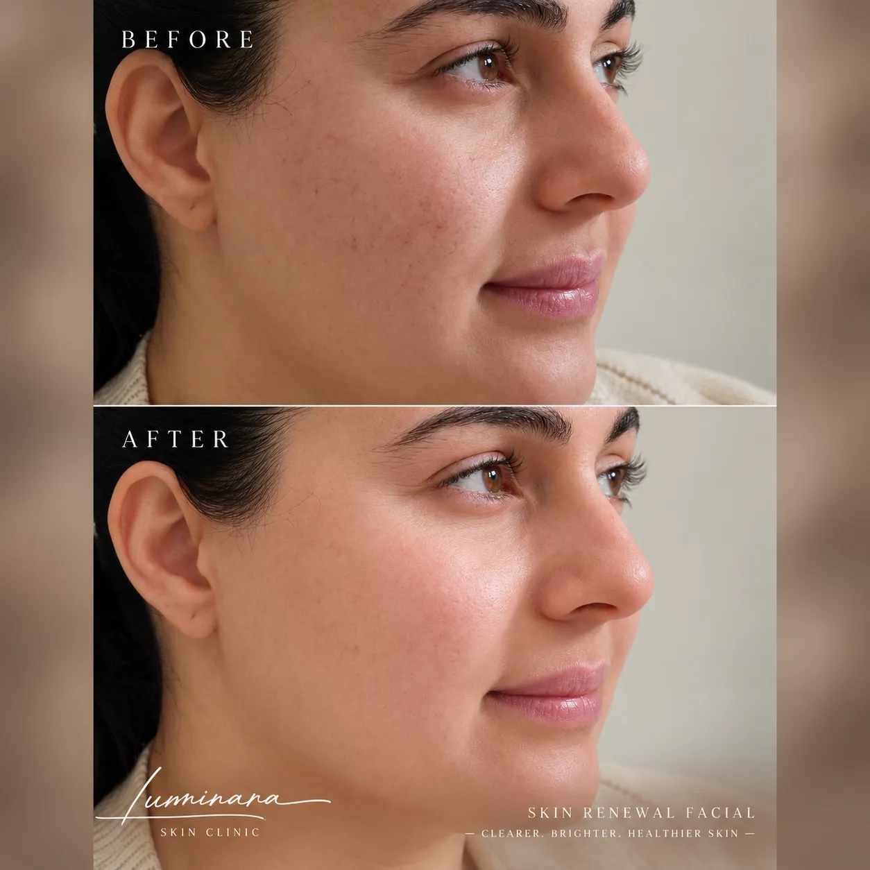 Luminara Skin Renewal Before & After_11zon