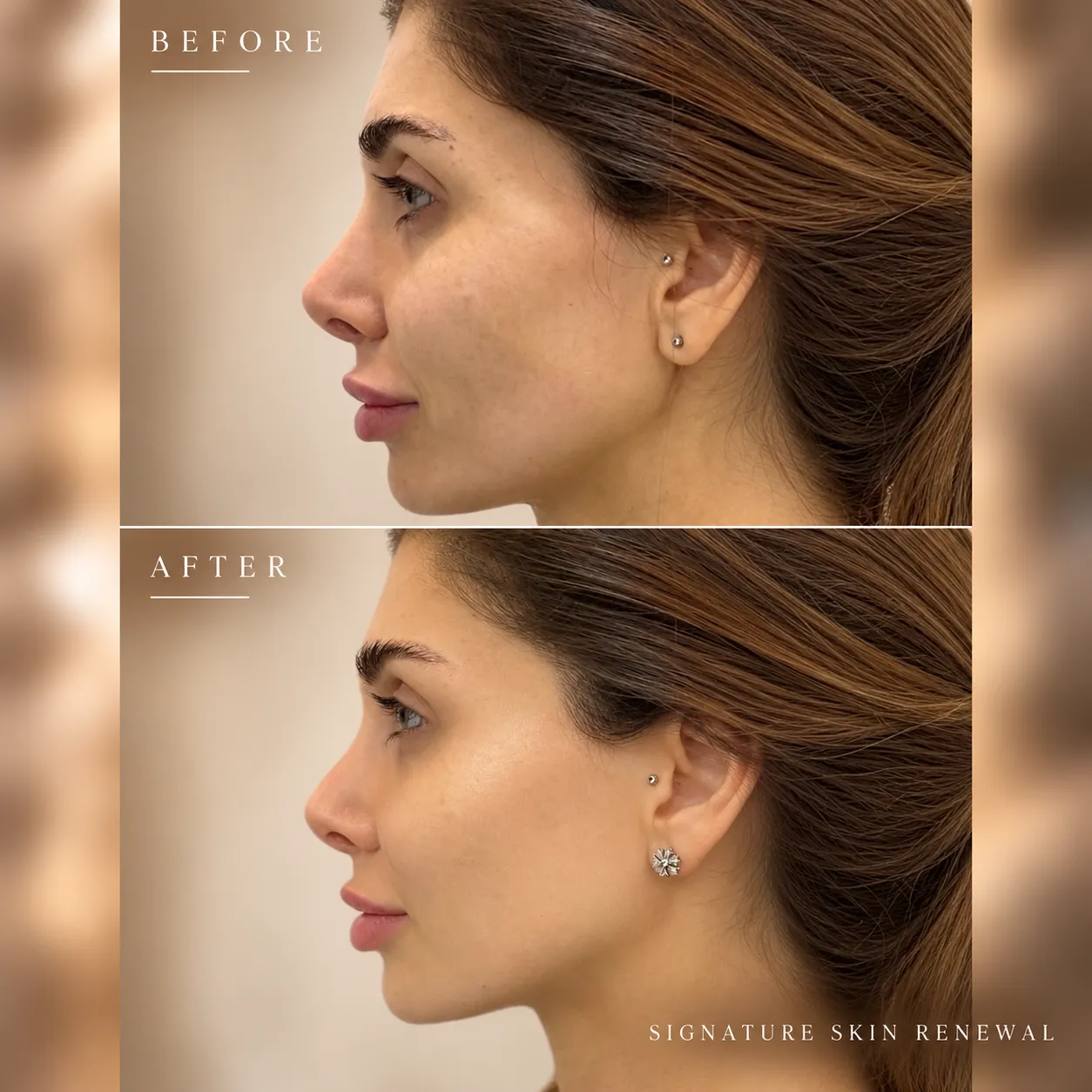 Signature Skin Renewal Before and After_11zon
