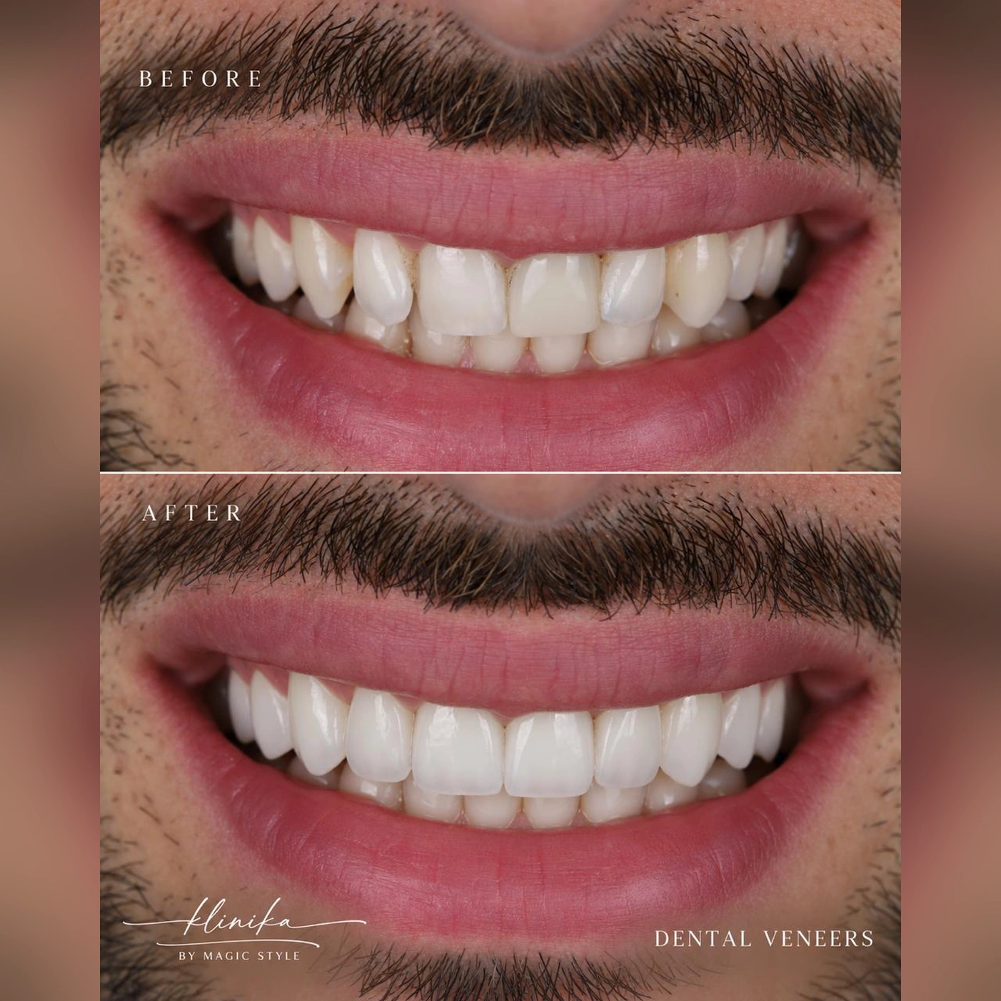 Smile Comparison 03 - Square