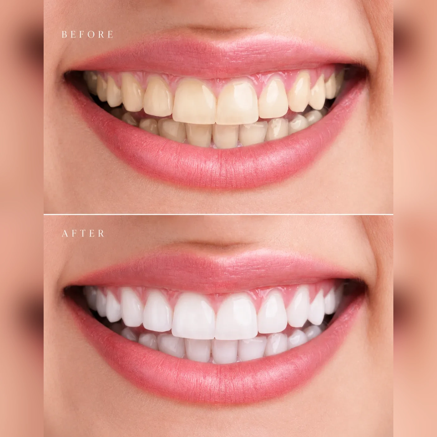 Smile Transformation - Square